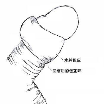 包皮嵌顿图示